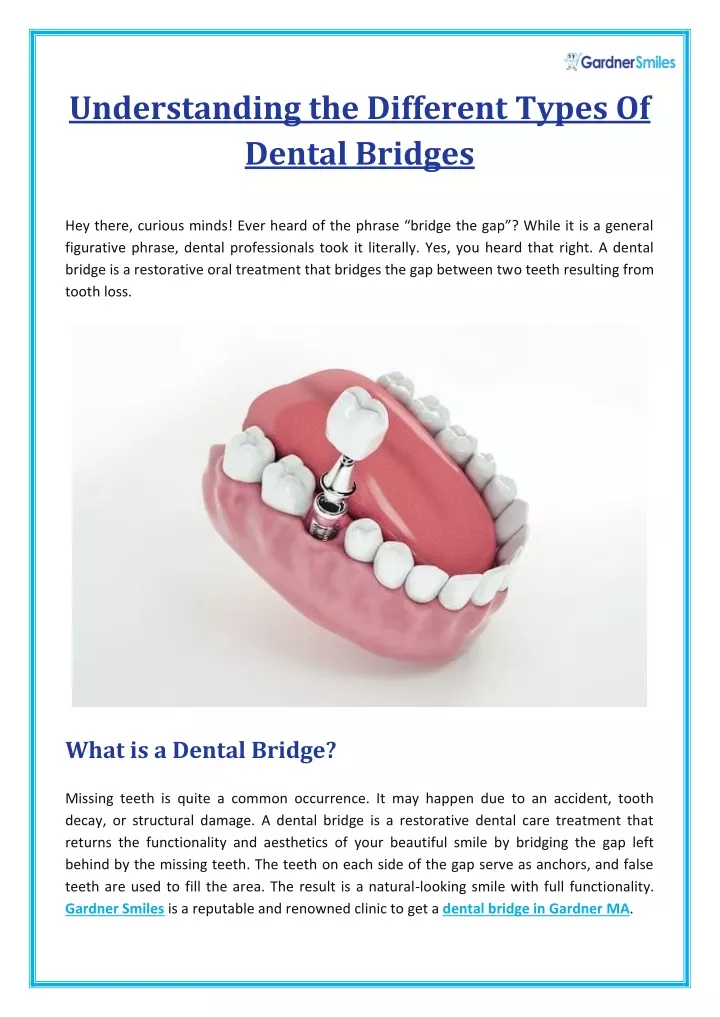 understanding the different types of dental