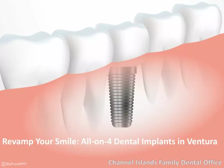 revamp your smile all on 4 dental implants