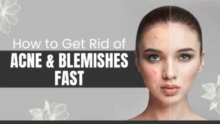 How to Get Rid of Acne and Blemishes Fast