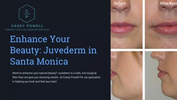 enhance your beauty juvederm in santa monica
