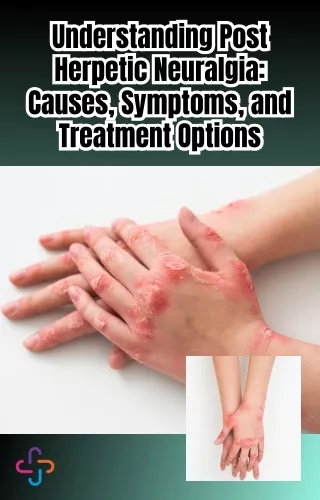 Understanding Post Herpetic Neuralgia Causes, Symptoms, and Treatment Options