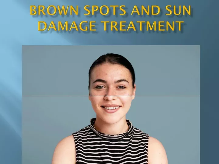 brown spots and sun damage treatment