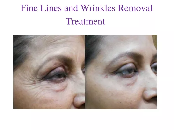 fine lines and wrinkles removal treatment