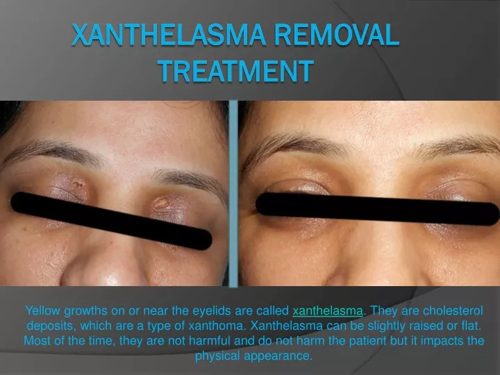 xanthelasma removal treatment