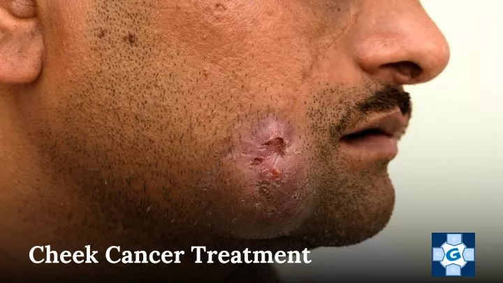 cheek cancer treatment