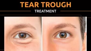Tear Trough Treatment- Under-eye Care For A Radiant Look