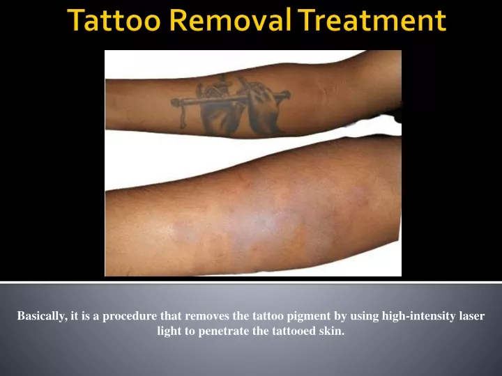 tattoo removal treatment