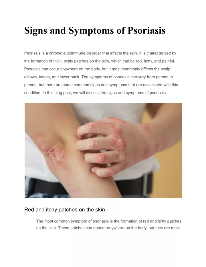 signs and symptoms of psoriasis