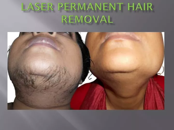 laser permanent hair removal