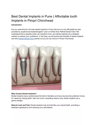 Best Dental Implants in Pune _ Affordable tooth Implants in Pimpri Chinchwad