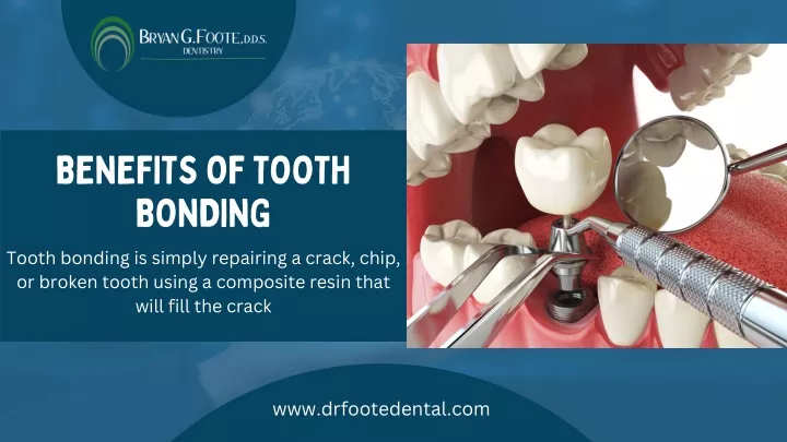 benefits of tooth bonding