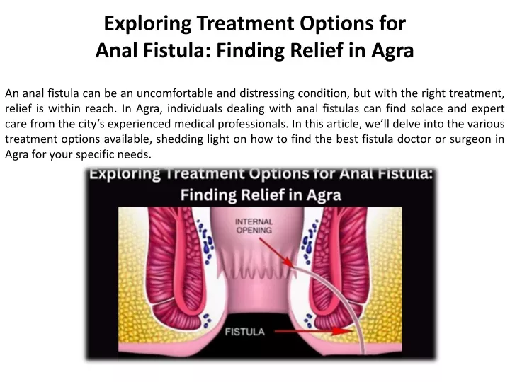 exploring treatment options for anal fistula