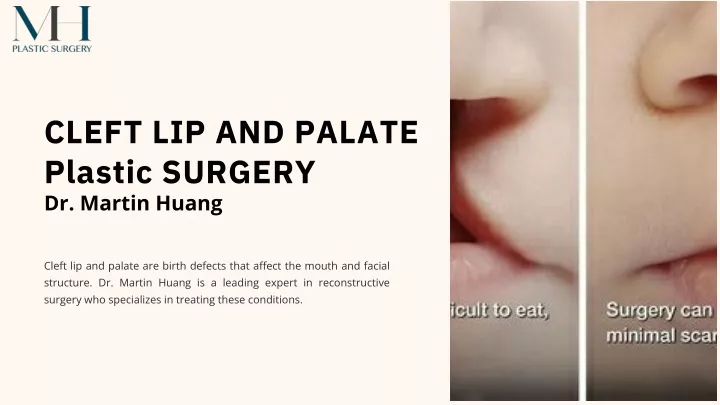 cleft lip and palate plastic surgery dr martin