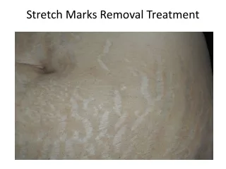 stretch marks removal treatment