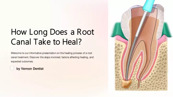 how long does a root how long does a root canal