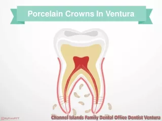 porcelain crowns in ventura