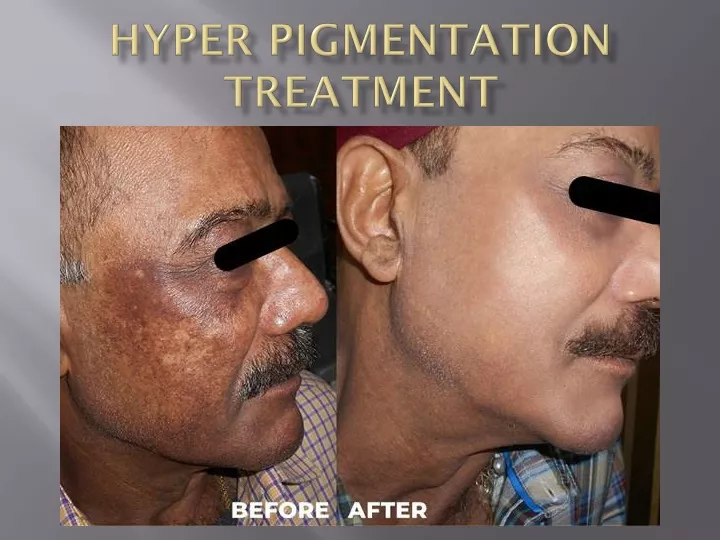 hyper pigmentation treatment