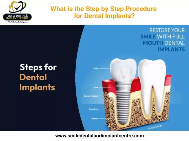what is the step by step procedure for dental