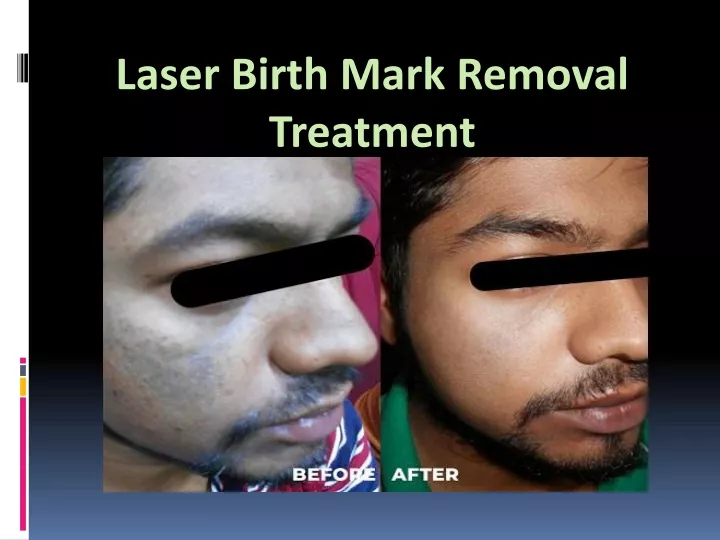 laser birth mark removal treatment