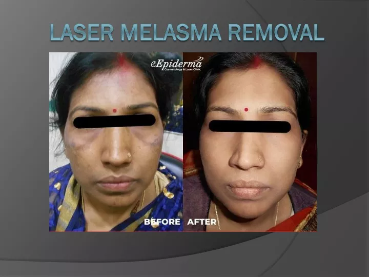laser melasma removal