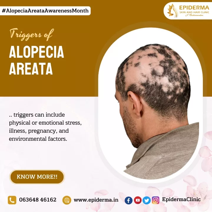 PPT - Triggers Of Alopecia Areata | Best Skin Clinic In Jayanagar ...