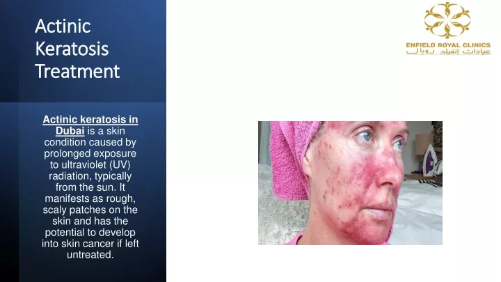 actinic keratosis treatment