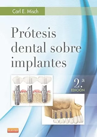 PDF Prótesis dental sobre implantes (Spanish Edition) download