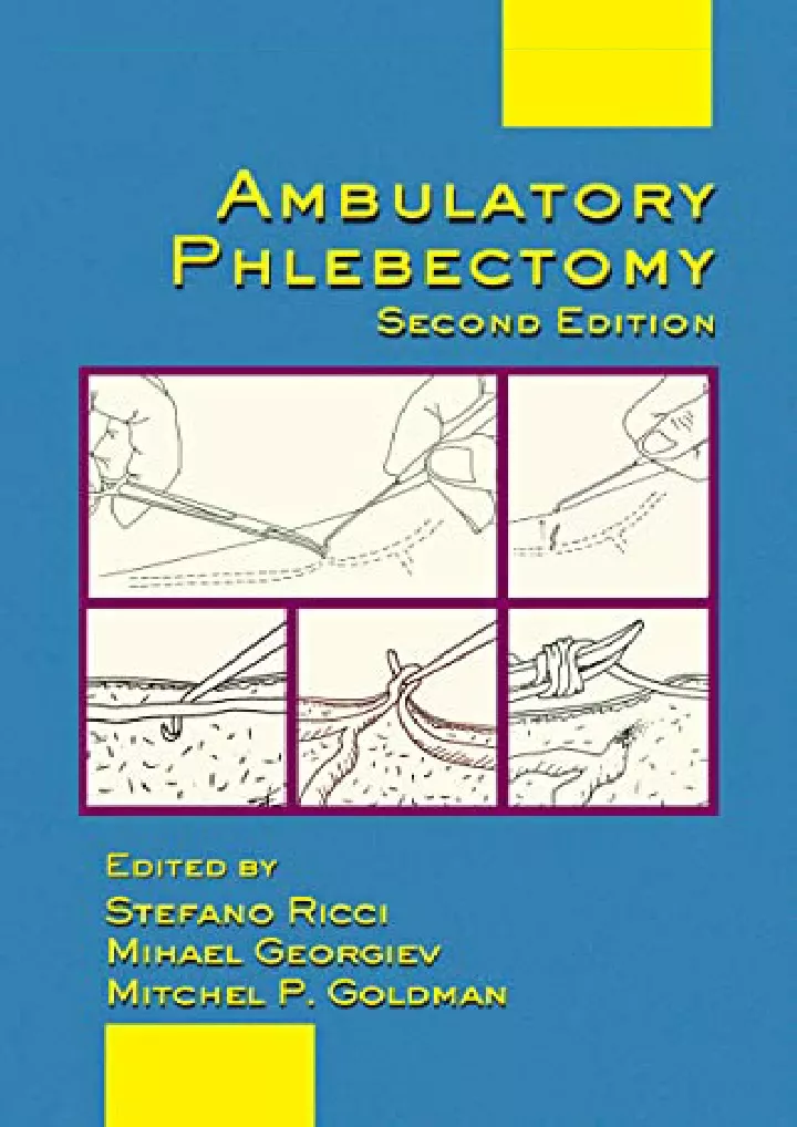 ambulatory phlebectomy basic and clinical