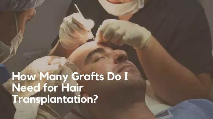 how many grafts do i need for hair transplantation