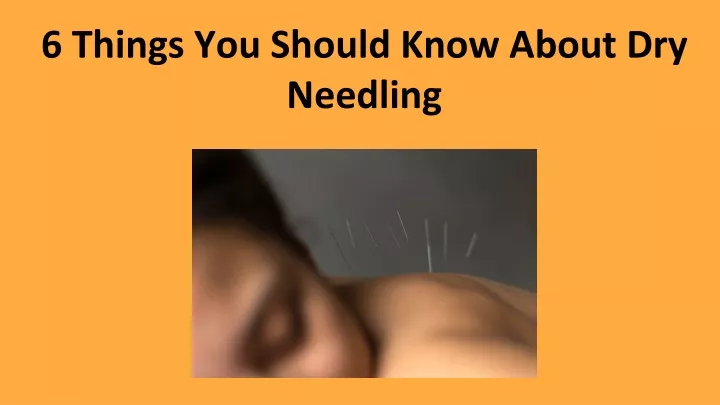 6 things you should know about dry needling