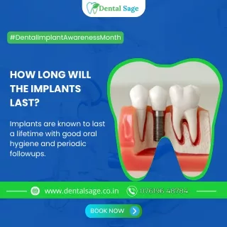How Long will the Dental Implants last | Dental Clinic Yelahanka | Dental Sage