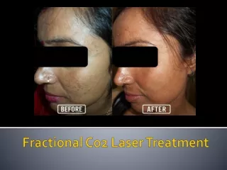 Fractional Co2 Laser Treatment