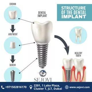 dental-implant-structure-medical-infographic-poster_1284-15063