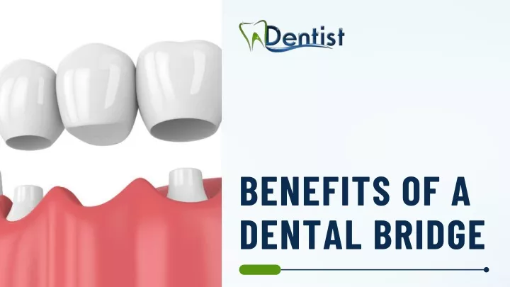 benefits of a dental bridge