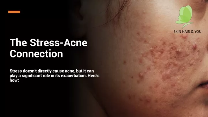 the stress acne connection