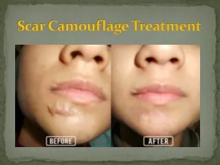 Scar Camouflage Treatment