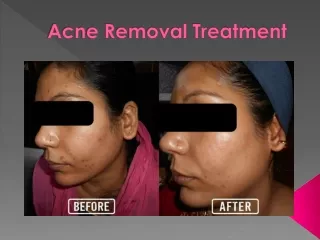 Acne Removal Treatment