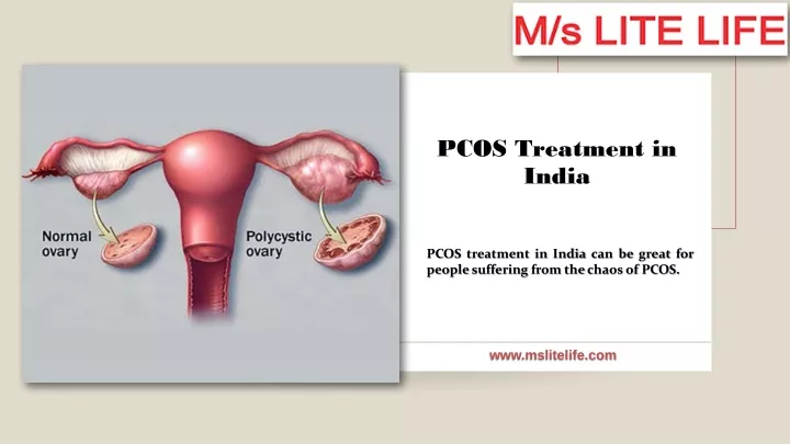 pcos treatment in india