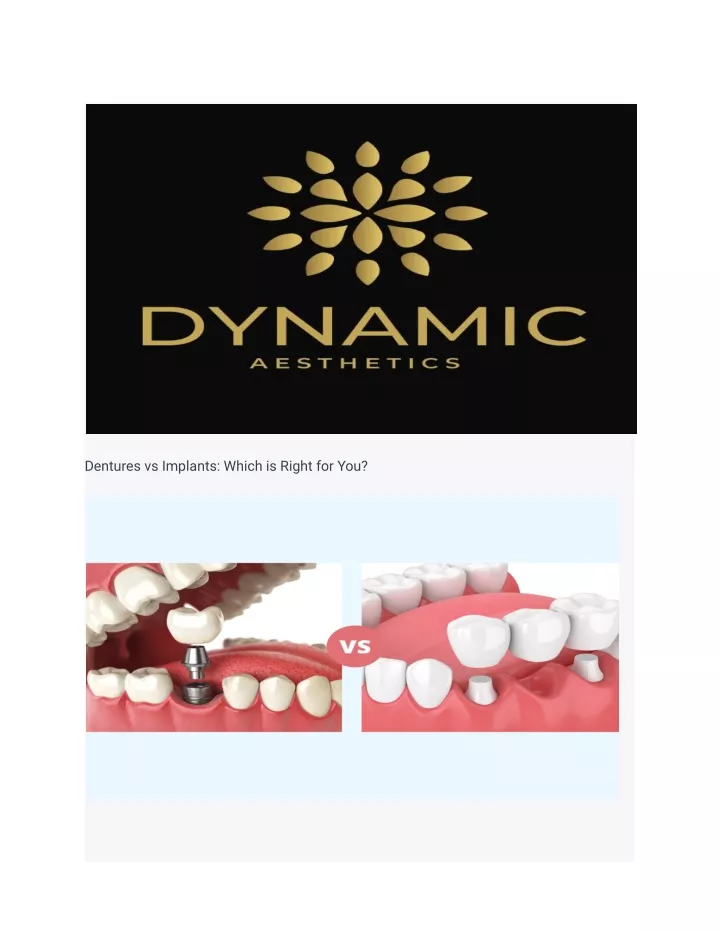 dentures vs implants which is right for you