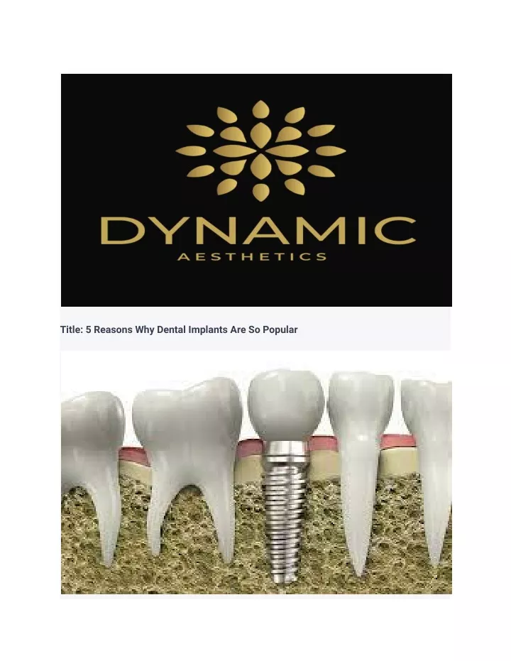 title 5 reasons why dental implants are so popular