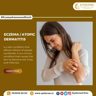 Eczema or Atopic Dermatitis | Best Skin Clinic in Jayanagar | Epiderma Clinic