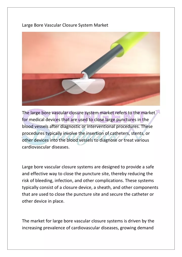 large bore vascular closure system market