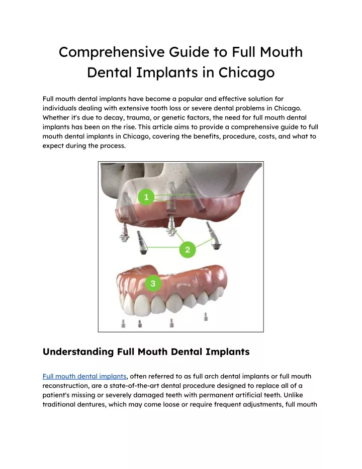 comprehensive guide to full mouth dental implants