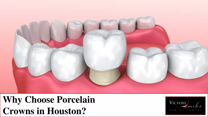 why choose porcelain crowns in houston