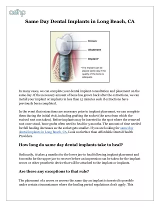Same Day Dental Implants in Long Beach, CA