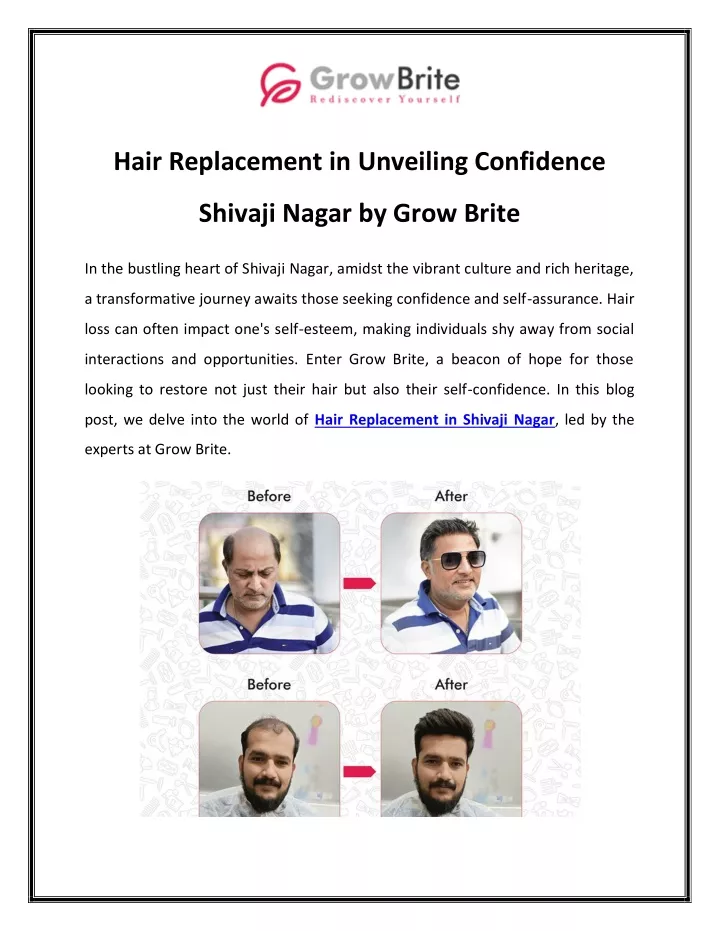 hair replacement in unveiling confidence