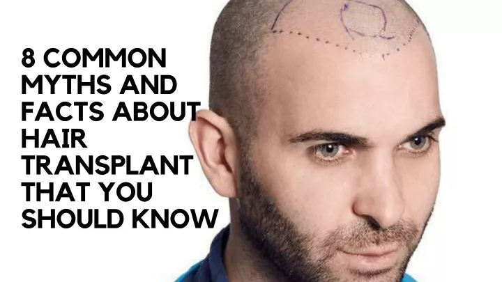 8 common myths and facts about hair transplant