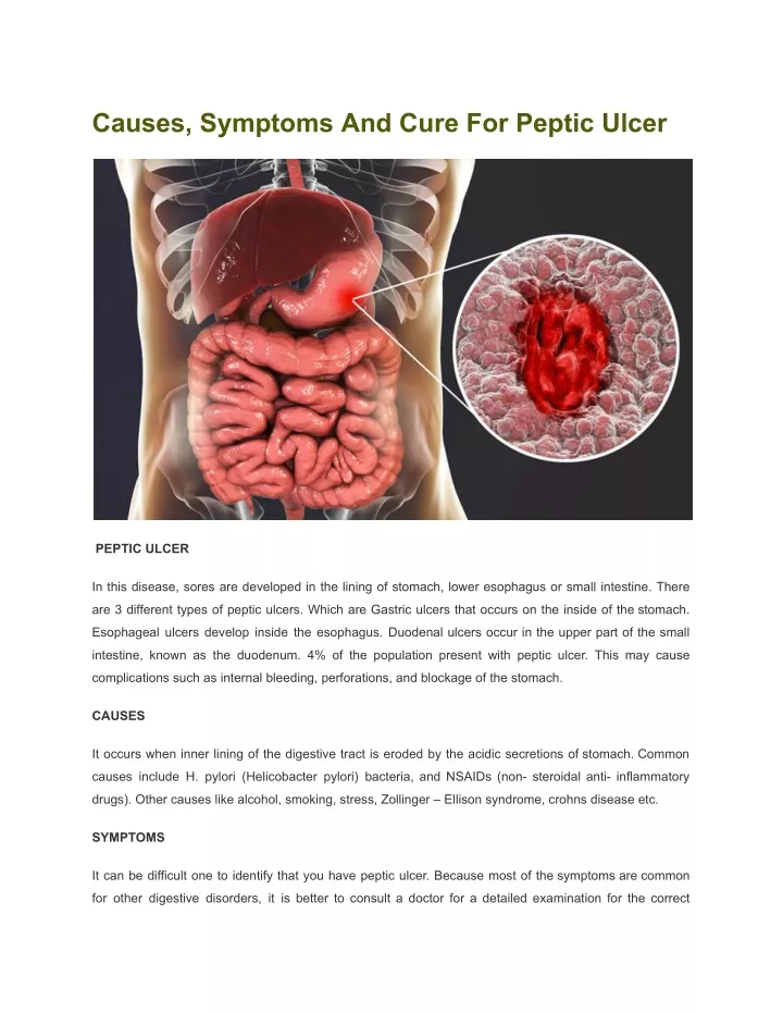 causes symptoms and cure for peptic ulcer