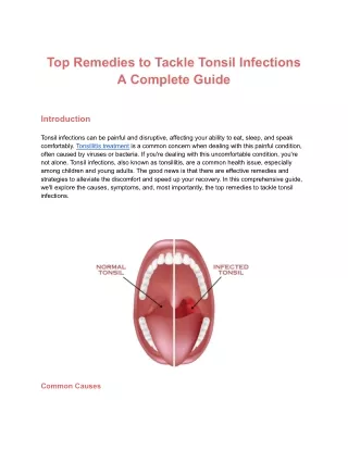Top Remedies to Tackle Tonsil Infections A Complete Guide