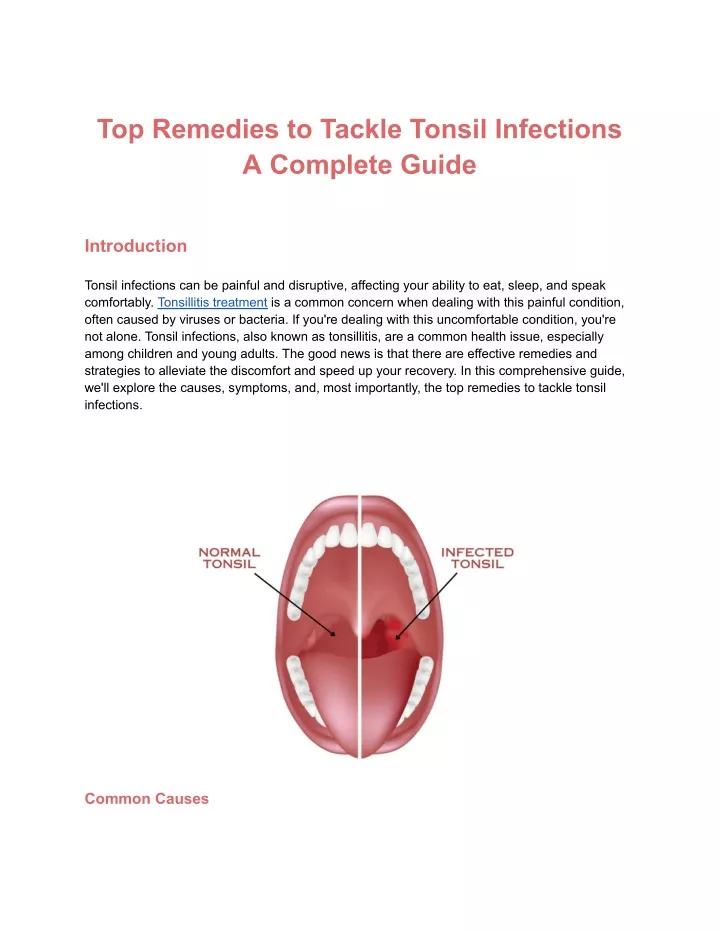 top remedies to tackle tonsil infections